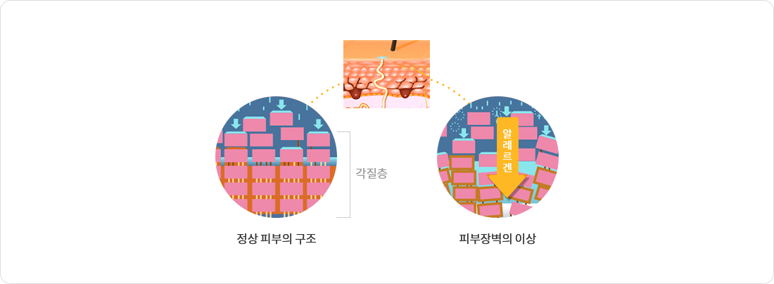 정상 피부의 구조, 피부장벽의 이상 비교 이미지